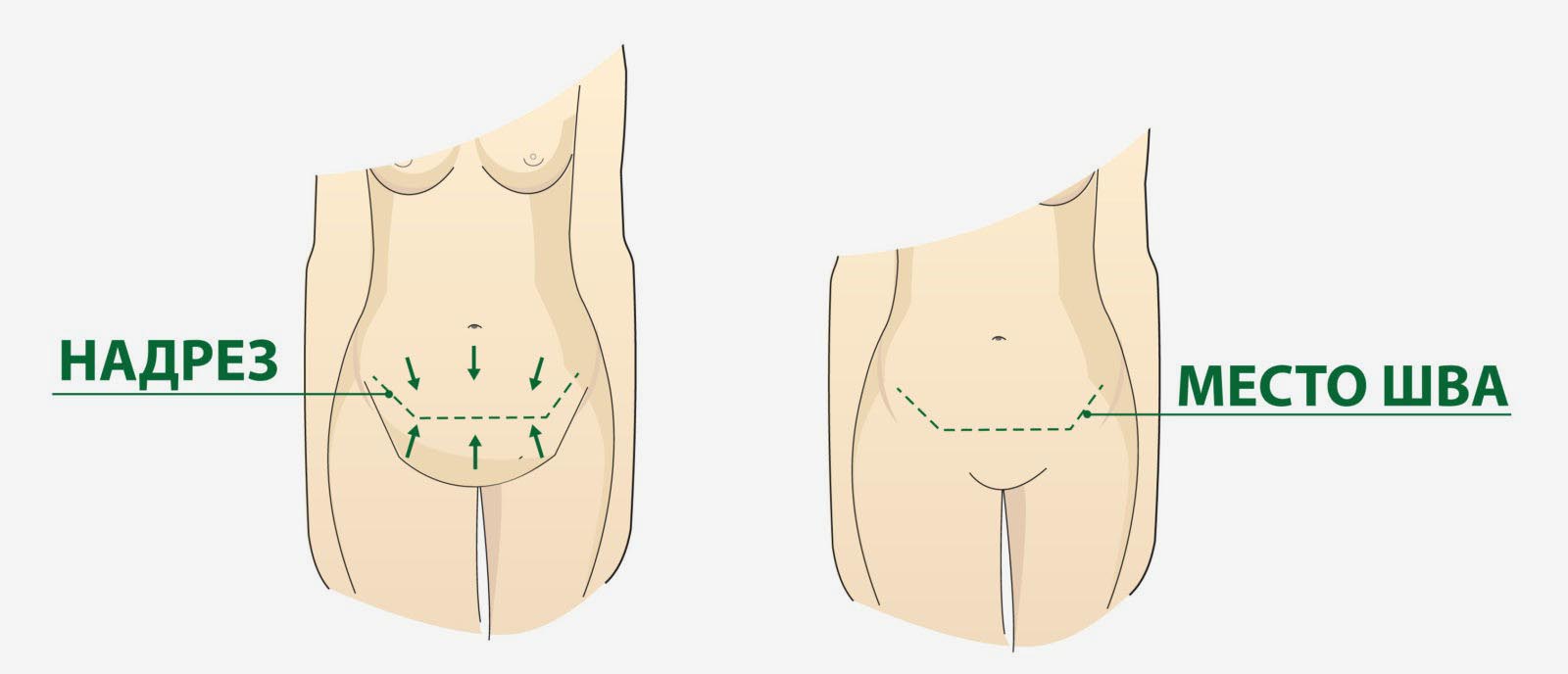 Абдоминопластика схема операции