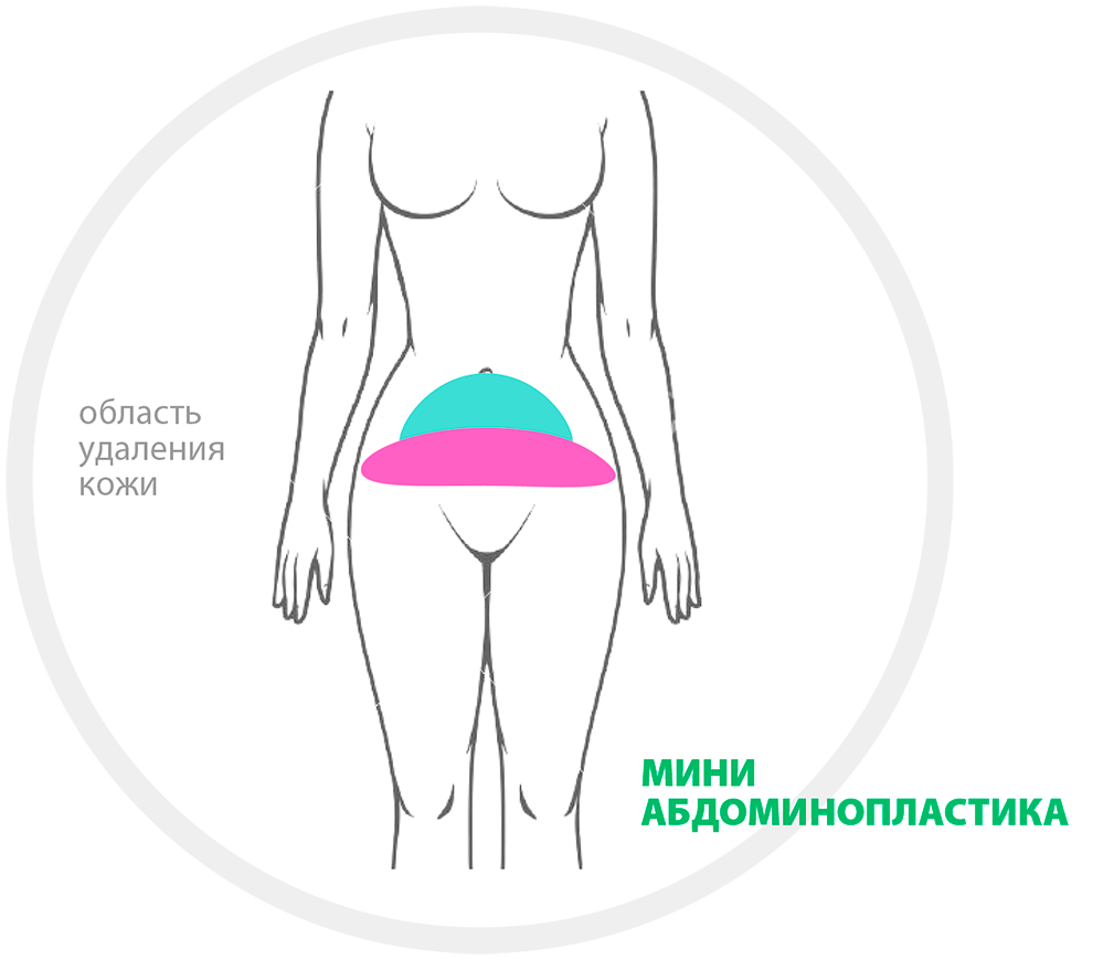 Абдоминопластика техника операции схема