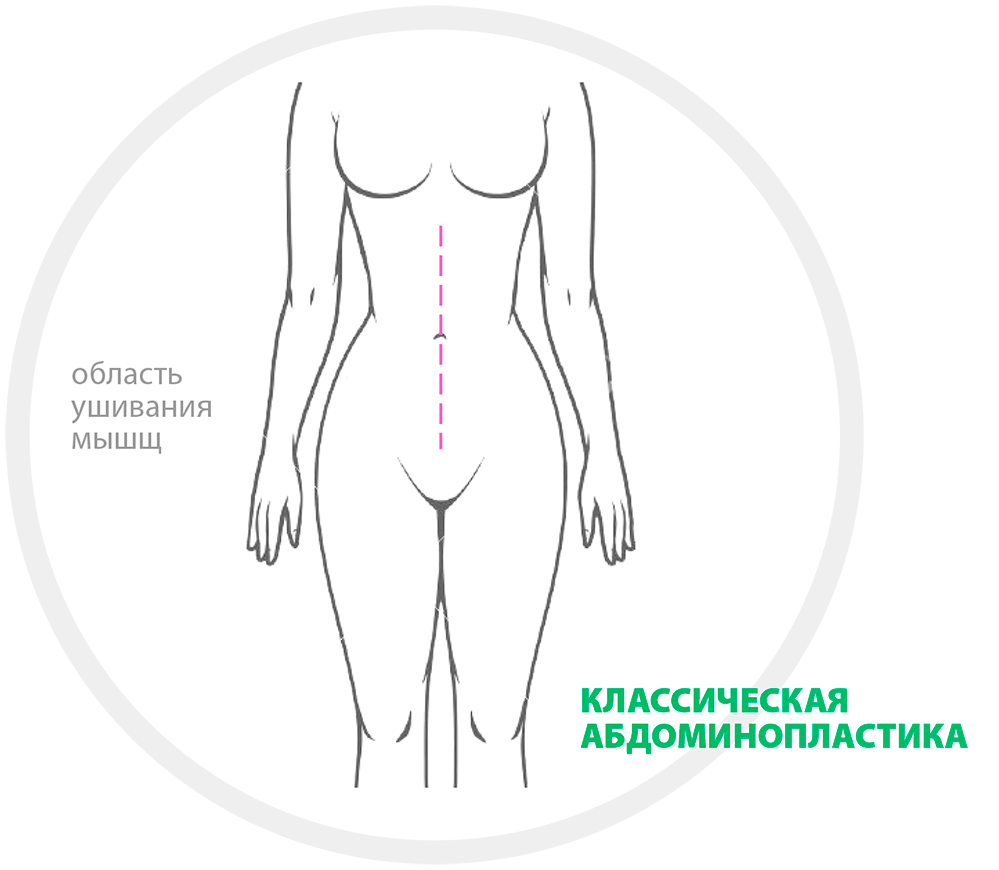 Абдоминопластика техника операции схема