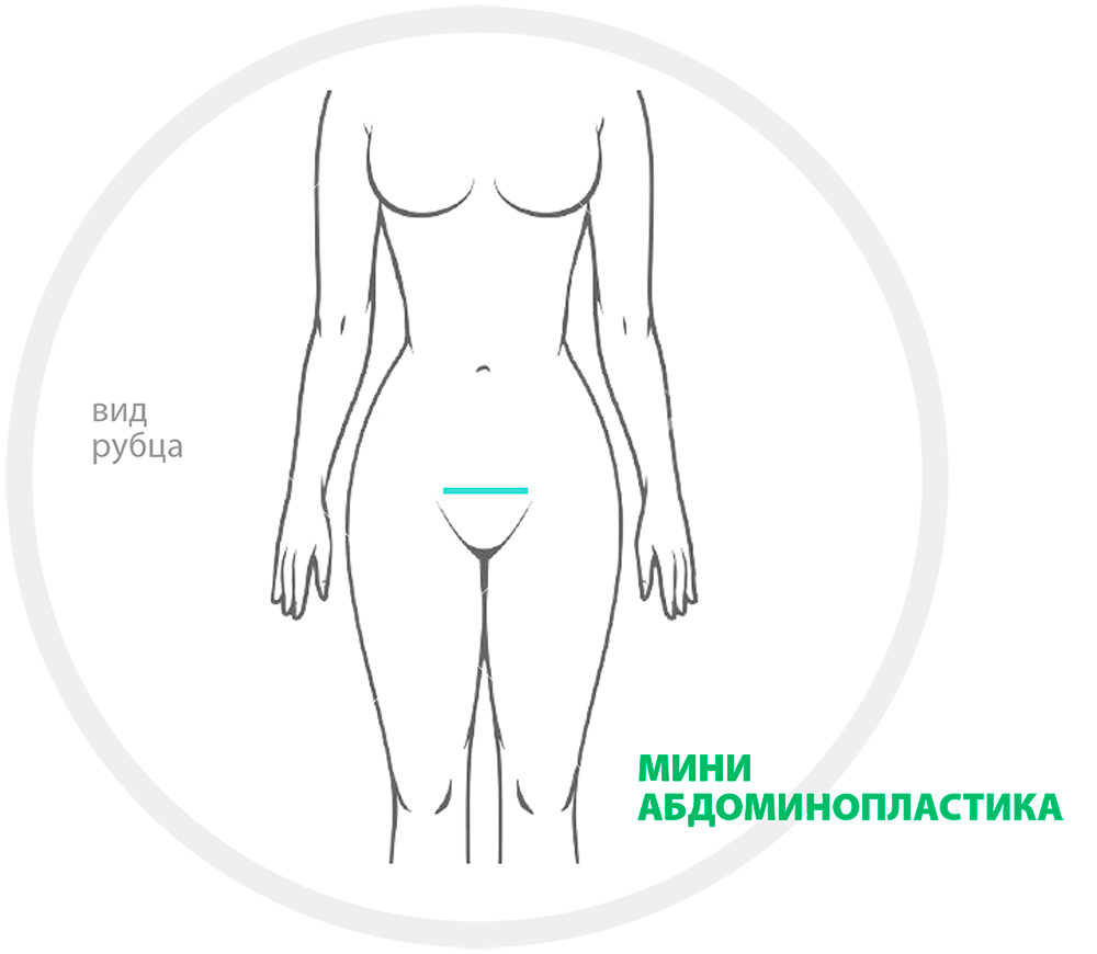 Абдоминопластика техника операции схема