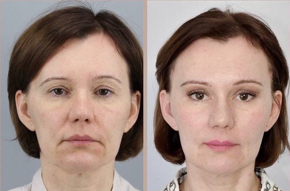 Эндоскопическая подтяжка лица фото до и после